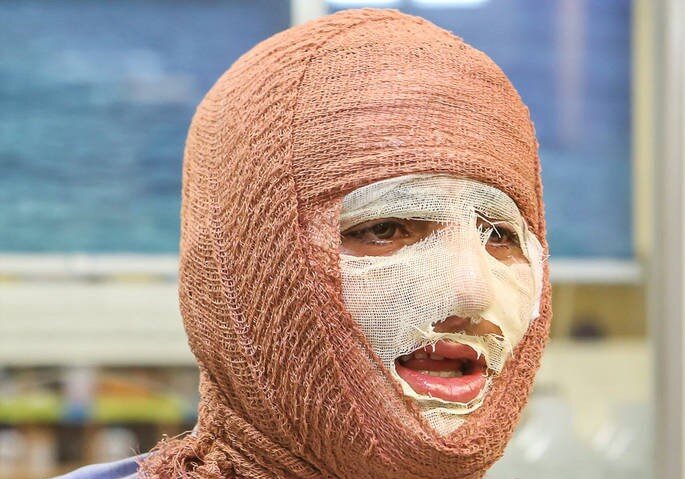 آیا بهبود کامل پس از سوختگیهای عمیق امکانپذیر است؟ آیا بهبود کامل پس از سوختگیهای عمیق امکانپذیر است؟