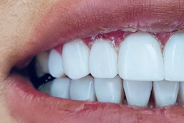 نگرانیهای دندانپزشکی در بارداری نگرانیهای دندانپزشکی در بارداری